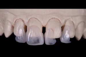 IPS e.max cosmetic veneer