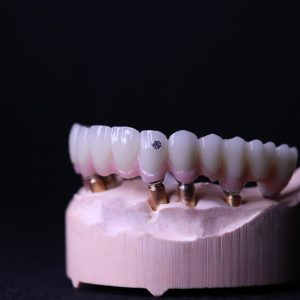 Implant crowns & bridges