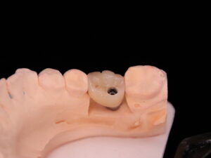 Screw retained implant zirconia crown